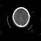 Skull fissure, epidural hematoma: CT - Computed tomography
